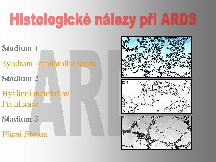 Stadium 1 Syndrom kapilárního leaku Stadium 2 Hyalinní membrány Proliferace Stadium 3 Plicní fibrosa