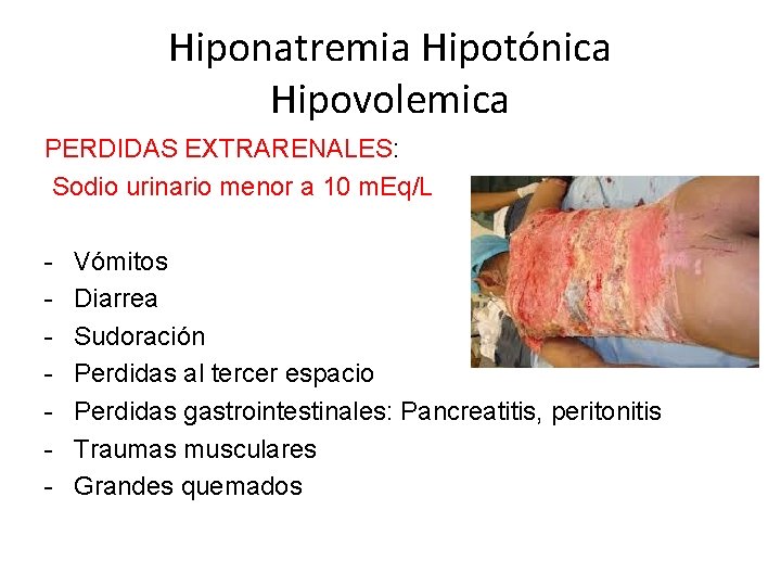 Hiponatremia Hipotónica Hipovolemica PERDIDAS EXTRARENALES: Sodio urinario menor a 10 m. Eq/L - Vómitos
