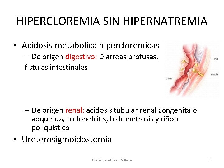 HIPERCLOREMIA SIN HIPERNATREMIA • Acidosis metabolica hipercloremicas – De origen digestivo: Diarreas profusas, fistulas
