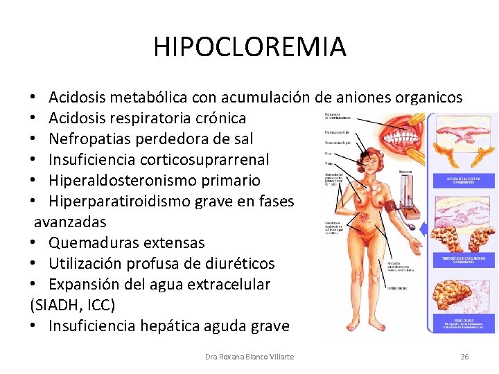 HIPOCLOREMIA • Acidosis metabólica con acumulación de aniones organicos • Acidosis respiratoria crónica •