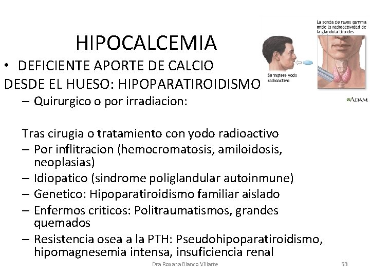 HIPOCALCEMIA • DEFICIENTE APORTE DE CALCIO DESDE EL HUESO: HIPOPARATIROIDISMO – Quirurgico o por