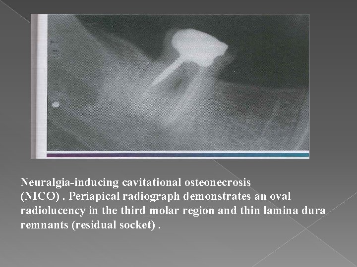 Neuralgia-inducing cavitational osteonecrosis (NICO). Periapical radiograph demonstrates an oval radiolucency in the third molar