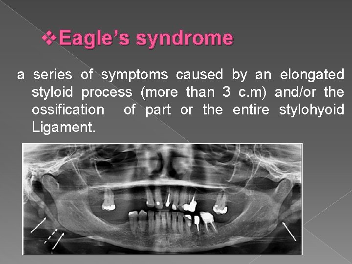 v. Eagle’s syndrome a series of symptoms caused by an elongated styloid process (more