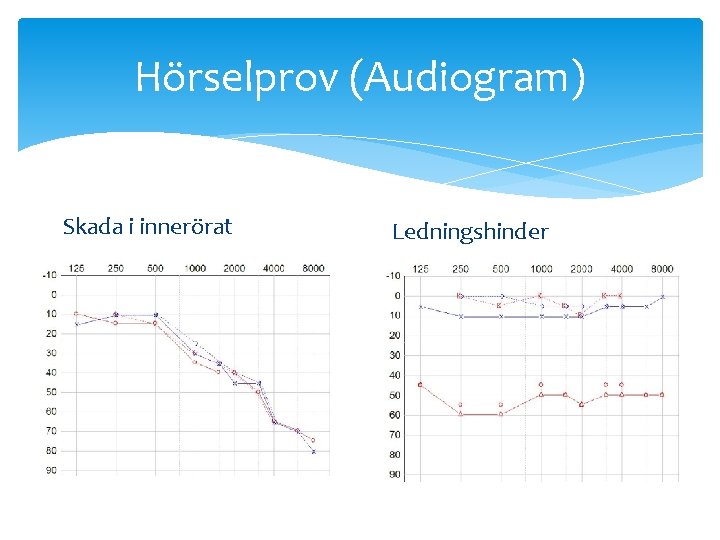 Hörselprov (Audiogram) Skada i innerörat Ledningshinder 