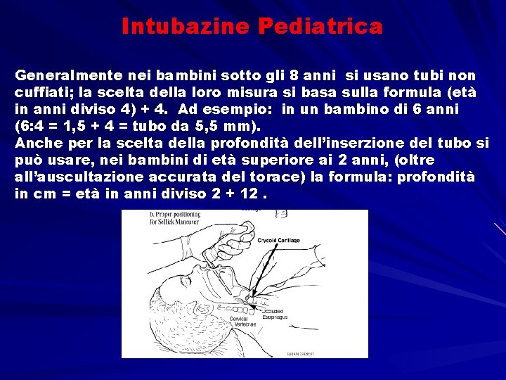 Intubazine Pediatrica Generalmente nei bambini sotto gli 8 anni si usano tubi non cuffiati;