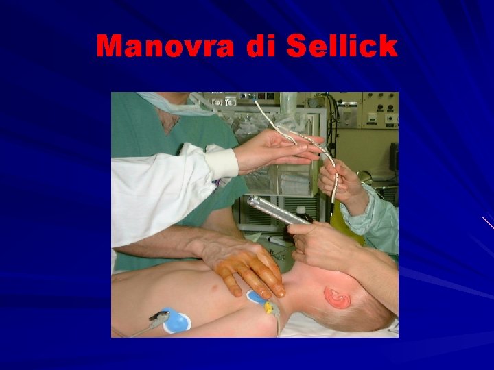 Manovra di Sellick 
