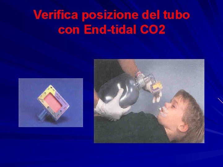 Verifica posizione del tubo con End-tidal CO 2 