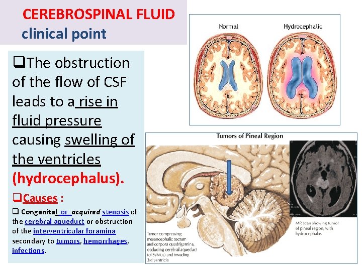 CEREBROSPINAL FLUID clinical point q. The obstruction of the flow of CSF leads to CEREBROSPINAL FLUID clinical point q. The obstruction of the flow of CSF leads to