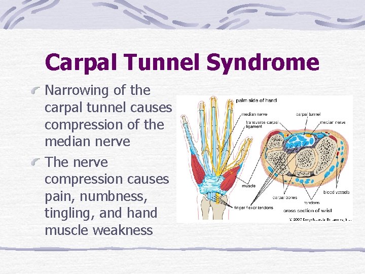 Carpal Tunnel Syndrome Narrowing of the carpal tunnel causes compression of the median nerve