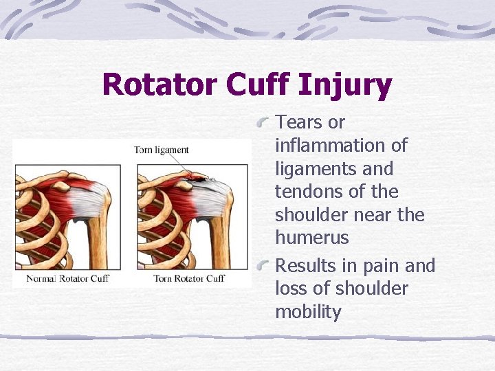 Rotator Cuff Injury Tears or inflammation of ligaments and tendons of the shoulder near