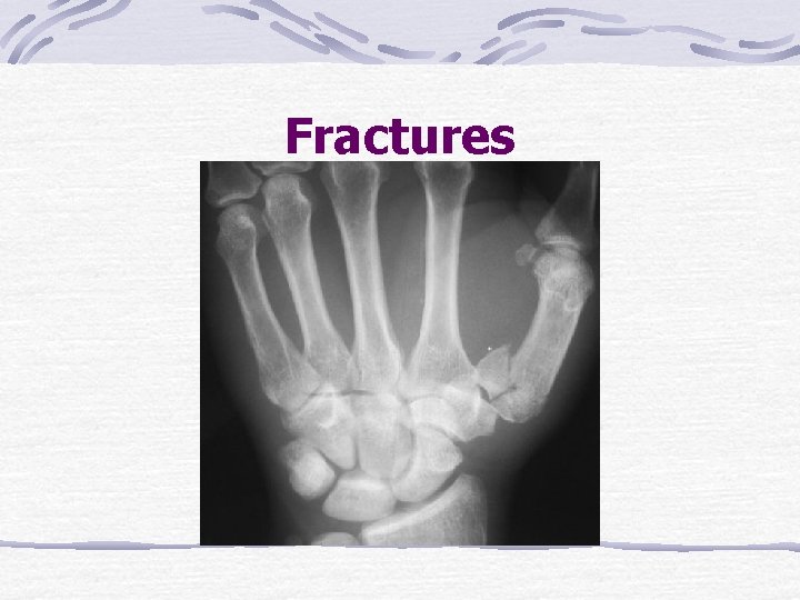 Fractures 