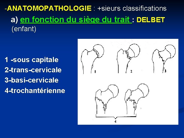 -ANATOMOPATHOLOGIE : +sieurs classifications a) en fonction du siège du trait : DELBET (enfant)