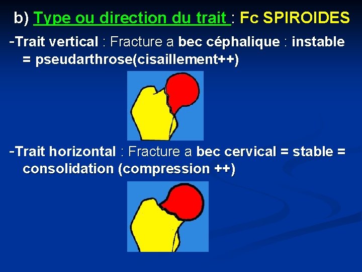 b) Type ou direction du trait : Fc SPIROIDES -Trait vertical : Fracture a