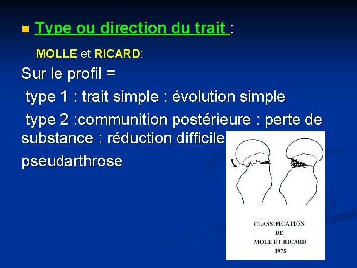 n Type ou direction du trait : MOLLE et RICARD: Sur le profil =