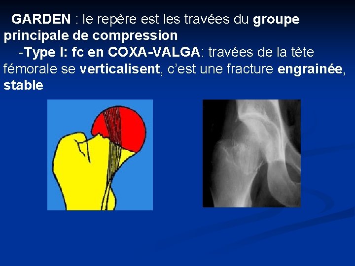 GARDEN : le repère est les travées du groupe principale de compression -Type I: