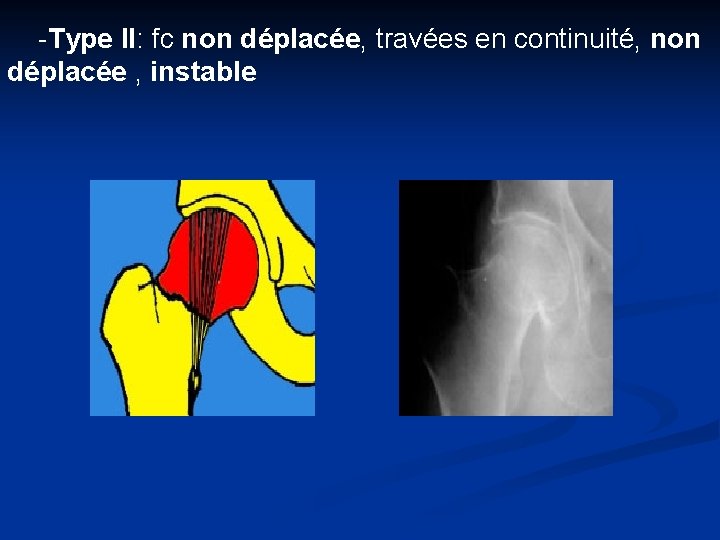 -Type II: fc non déplacée, travées en continuité, non déplacée , instable 