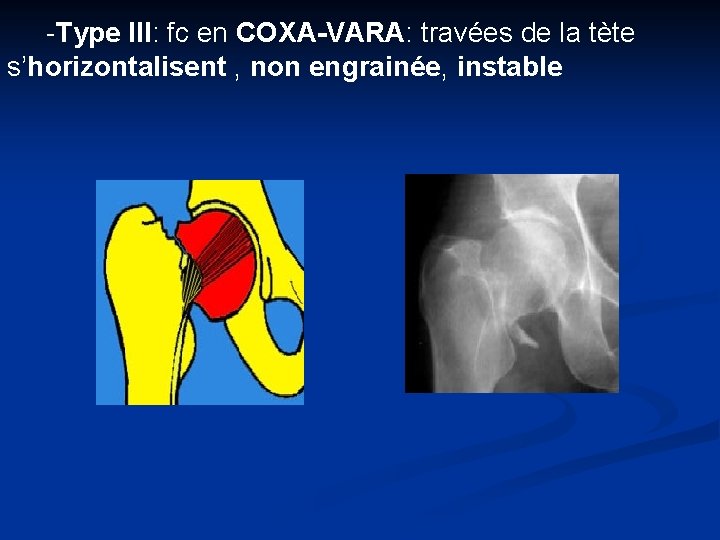 -Type III: fc en COXA-VARA: COXA-VARA travées de la tète s’horizontalisent , non engrainée,