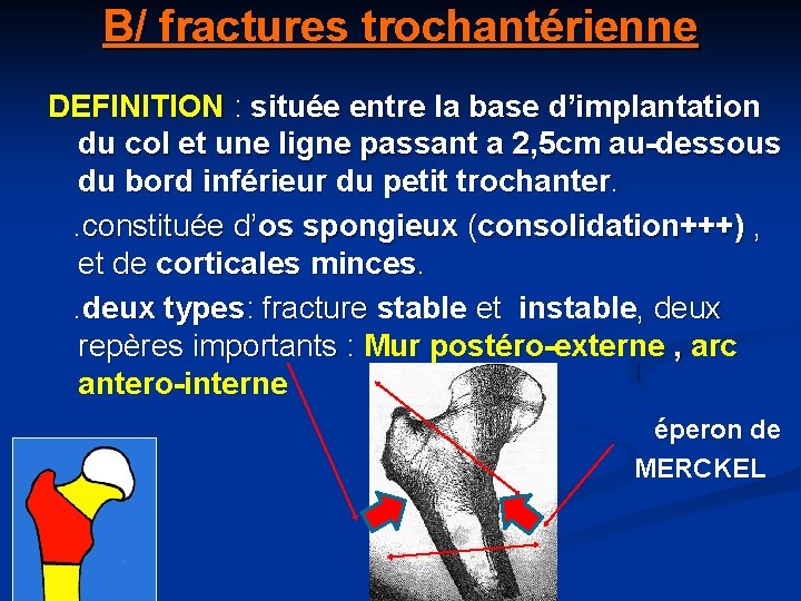 B/ fractures trochantérienne DEFINITION : située entre la base d’implantation du col et une