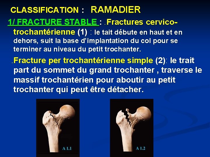 CLASSIFICATION : RAMADIER 1/ FRACTURE STABLE : . Fractures cervicotrochantérienne (1) : le tait
