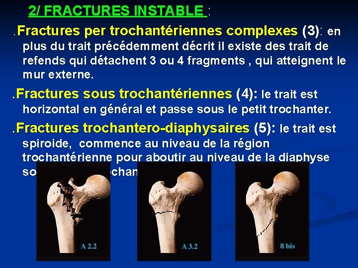 2/ FRACTURES INSTABLE : . Fractures per trochantériennes complexes (3): en plus du trait