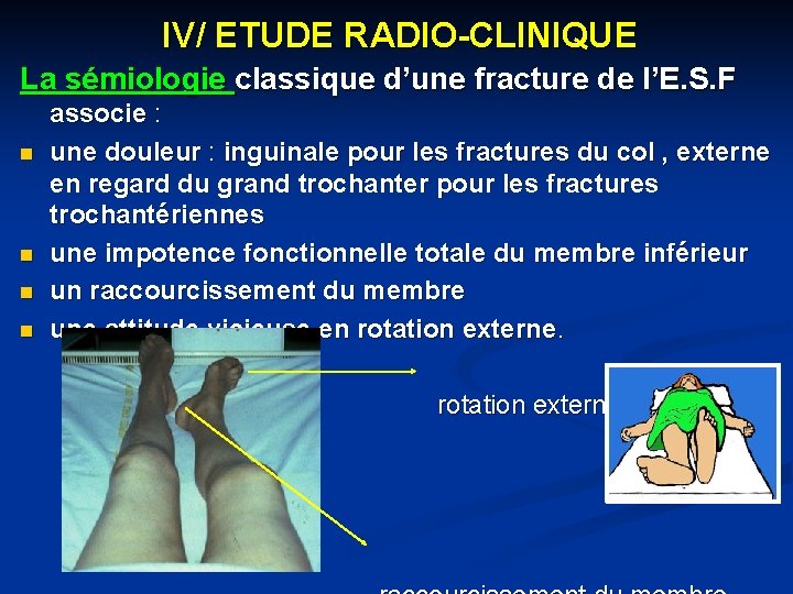 IV/ ETUDE RADIO-CLINIQUE La sémiologie classique d’une fracture de l’E. S. F n n