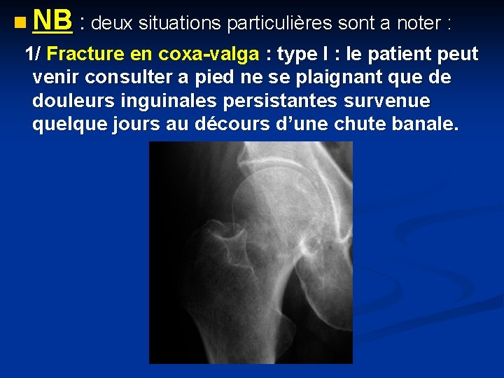 n NB : deux situations particulières sont a noter : 1/ Fracture en coxa-valga