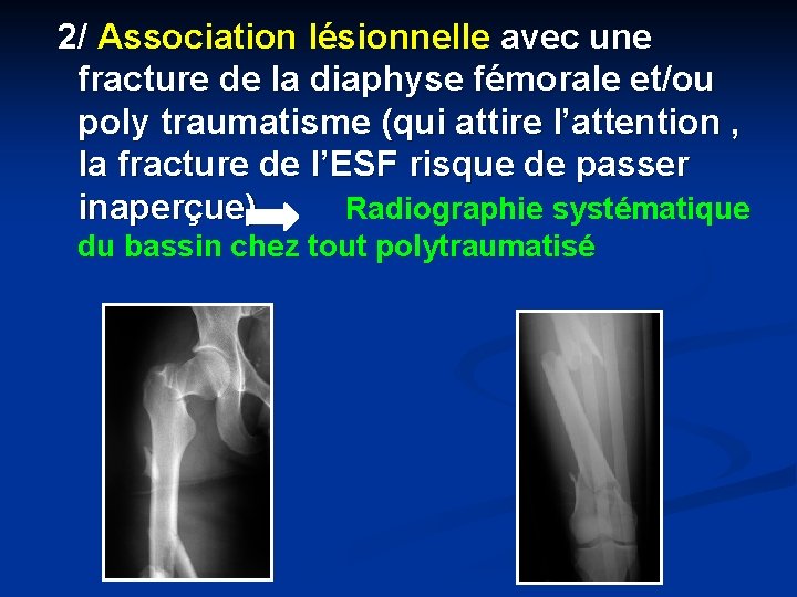 2/ Association lésionnelle avec une fracture de la diaphyse fémorale et/ou poly traumatisme (qui