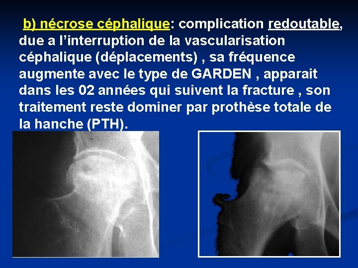 b) nécrose céphalique: complication redoutable, due a l’interruption de la vascularisation céphalique (déplacements) ,