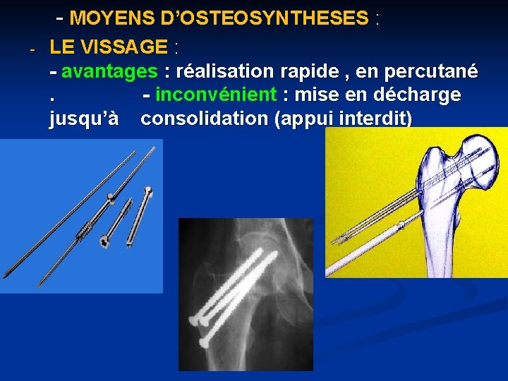 - MOYENS D’OSTEOSYNTHESES : - LE VISSAGE : - avantages : réalisation rapide ,