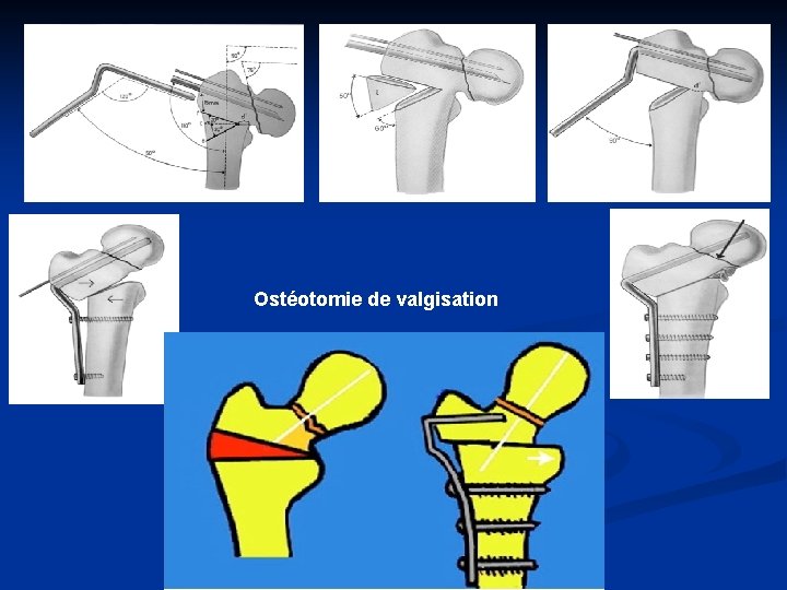 Ostéotomie de valgisation 