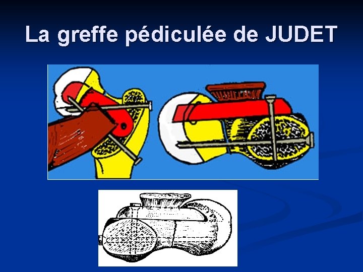 La greffe pédiculée de JUDET 