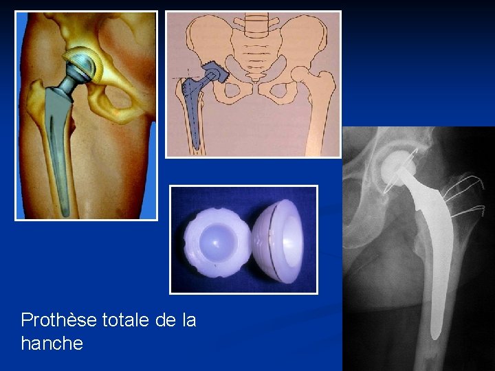 Prothèse totale de la hanche 