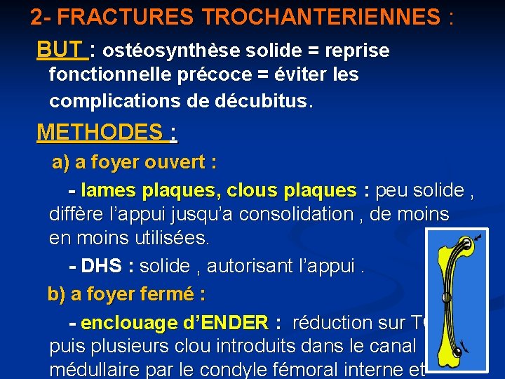 2 - FRACTURES TROCHANTERIENNES : BUT : ostéosynthèse solide = reprise fonctionnelle précoce =
