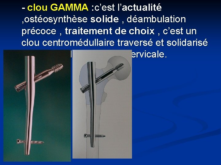 - clou GAMMA : c’est l’actualité , ostéosynthèse solide , déambulation précoce , traitement
