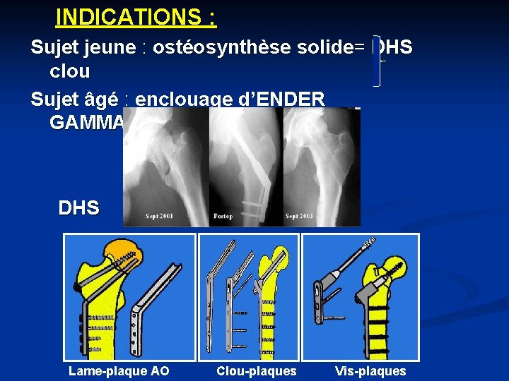 INDICATIONS : Sujet jeune : ostéosynthèse solide= DHS clou Sujet âgé : enclouage d’ENDER