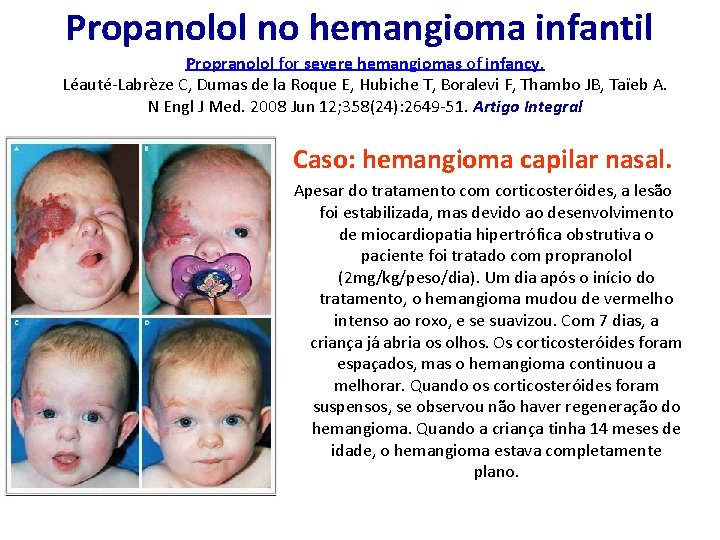Propanolol no hemangioma infantil Propranolol for severe hemangiomas of infancy. Léauté-Labrèze C, Dumas de