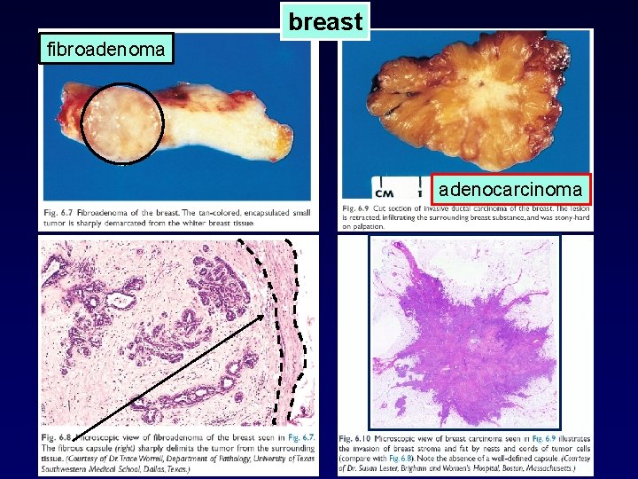 breast fibroadenoma adenocarcinoma 