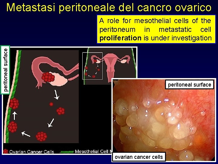 Metastasi peritoneale del cancro ovarico peritoneal surface A role for mesothelial cells of the