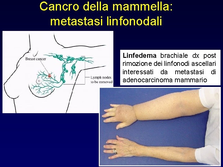 Cancro della mammella: metastasi linfonodali Linfedema brachiale dx post rimozione dei linfonodi ascellari interessati