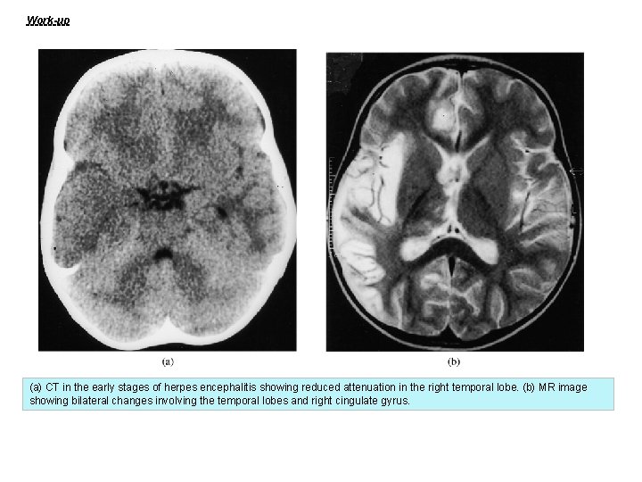 Work-up (a) CT in the early stages of herpes encephalitis showing reduced attenuation in