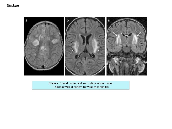 Work-up Bilateral frontal cortex and subcortical white matter This is a typical pattern for