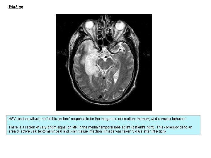 Work-up HSV tends to attack the "limbic system" responsible for the integration of emotion,