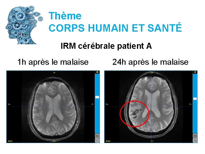 Thème CORPS HUMAIN ET SANTÉ IRM cérébrale patient A 1 h après le malaise
