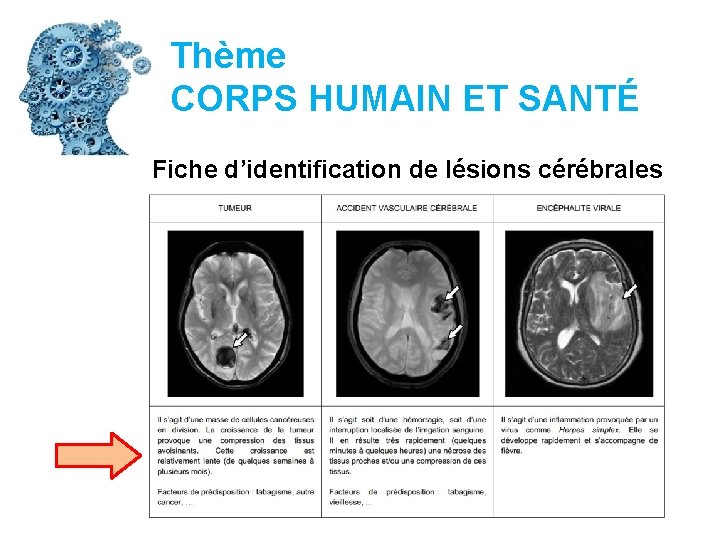 Thème CORPS HUMAIN ET SANTÉ Fiche d’identification de lésions cérébrales 
