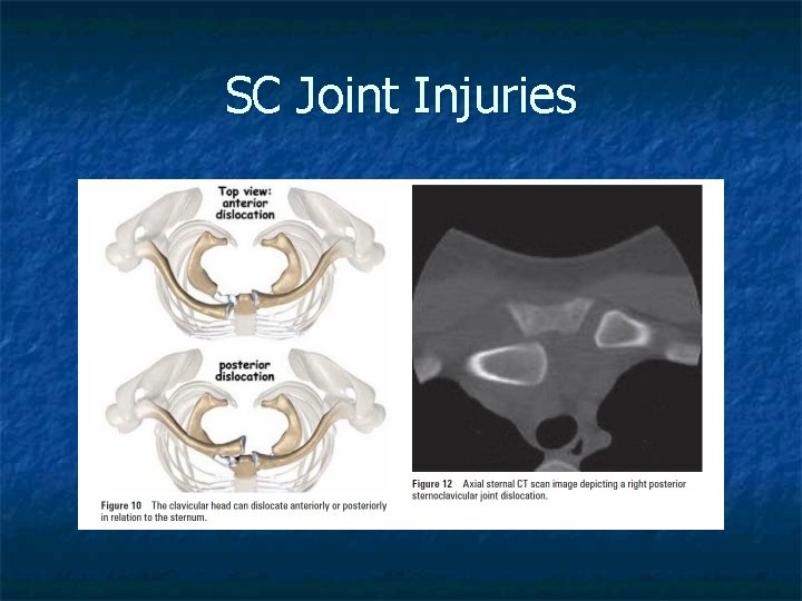 SC Joint Injuries 