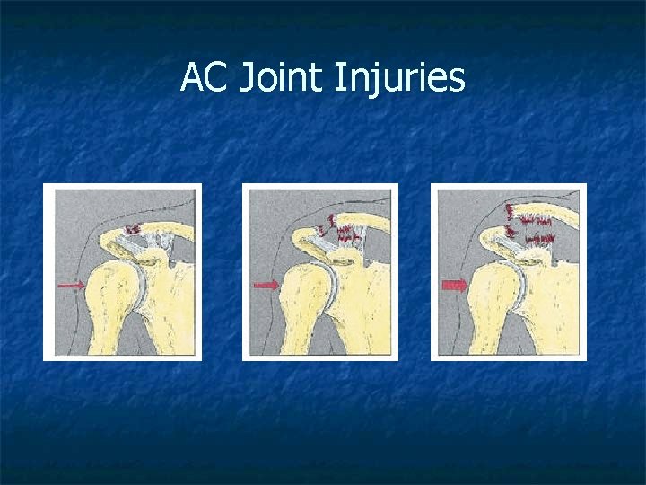 AC Joint Injuries 