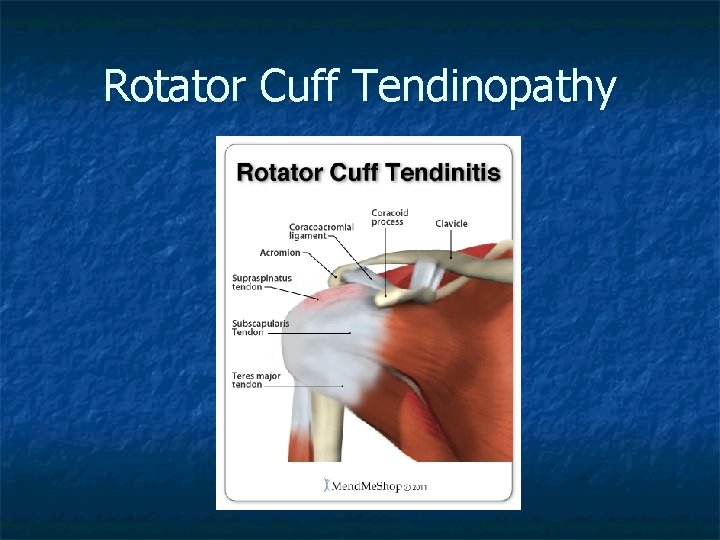 Rotator Cuff Tendinopathy 