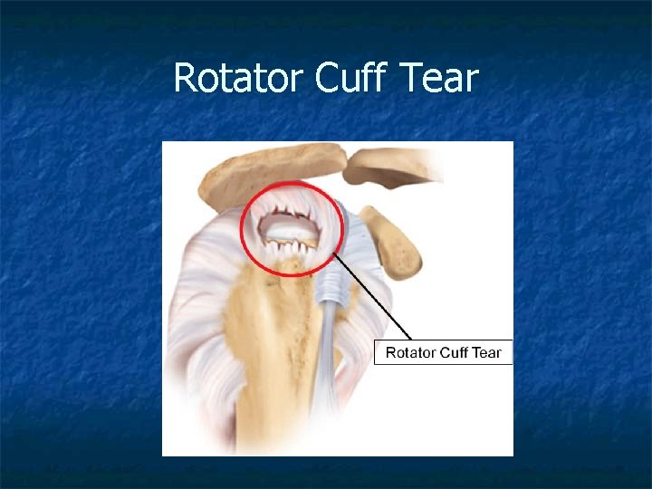 Rotator Cuff Tear 