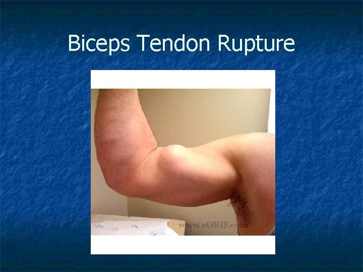 Biceps Tendon Rupture 