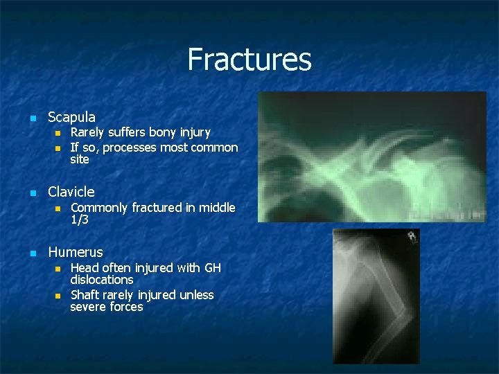 Fractures n Scapula n n n Clavicle n n Rarely suffers bony injury If